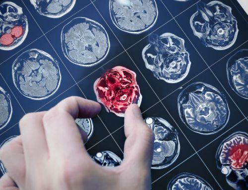 Benefits of Early Intervention for Dementia by Dr Seng Kok Han