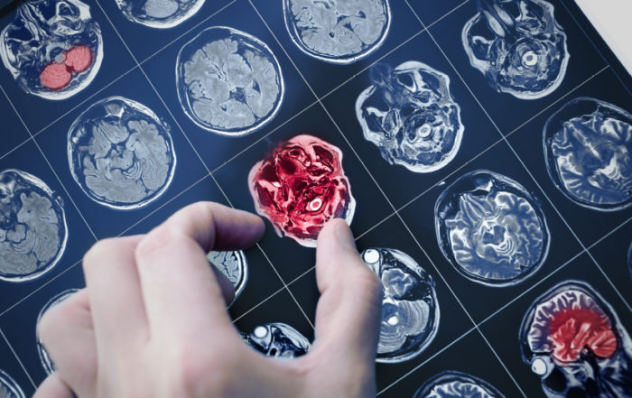 Doctor reviewing a brain scan highlighting an area of concern related to dementia and cognitive decline.