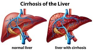 cirhossis-of-the-liver-and-healthy-liver-1