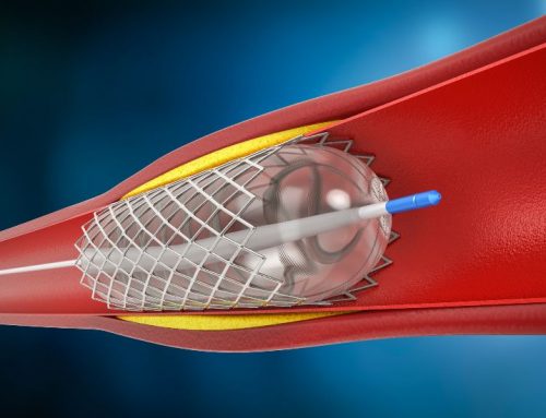 Everything You Need to Know about Angioplasty