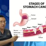 A New Blood Test for Stomach Cancer | Dr Aaron Poh