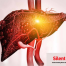 Medical illustration of a diseased liver showing fatty liver changes, inflammation, and scarring, with the text “Silent Killer” in the corner.
