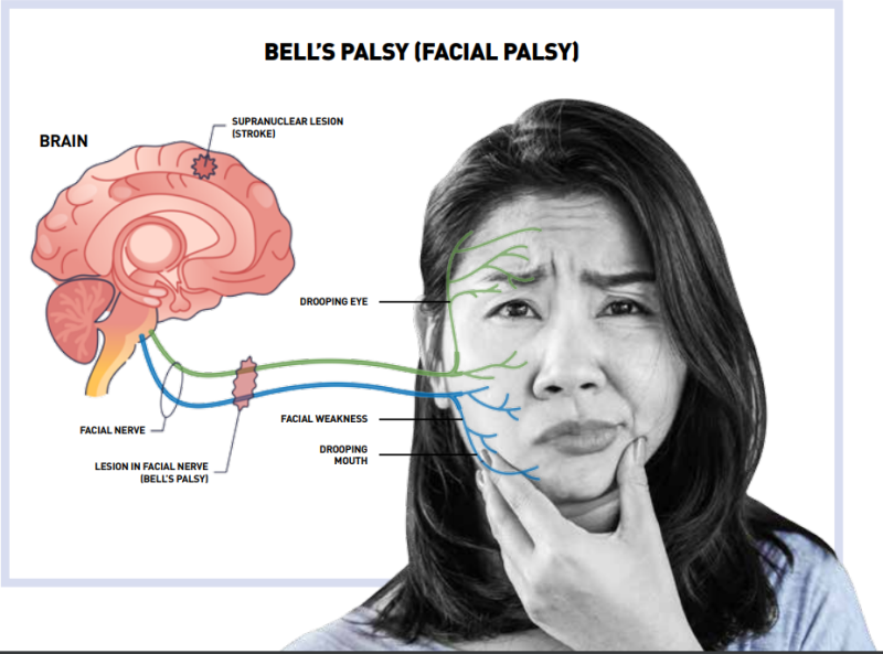 Warning Bell’s Treatment of Bell’s Palsy Using BTL Emface by Dr Rohan