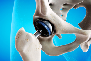 Illustration showing a hip joint implant inserted into the pelvis and femur, highlighting how metal ions from joint implants can interact with bone tissue.