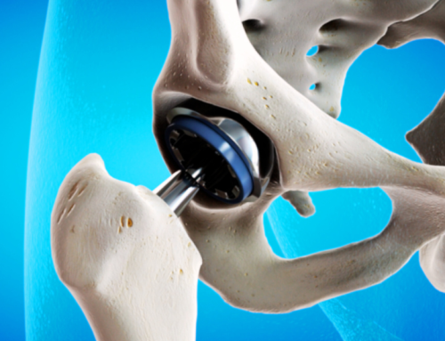 The Long-Term Effects of Bone Implants Your Doctors Don’t Tell You