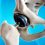 Illustration showing a hip joint implant inserted into the pelvis and femur, highlighting how metal ions from joint implants can interact with bone tissue.
