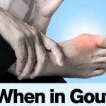 When in Gout : The Beginner’s Guide To Gout | Dr Annie Law, Senior Consultant Rheumotoiogist