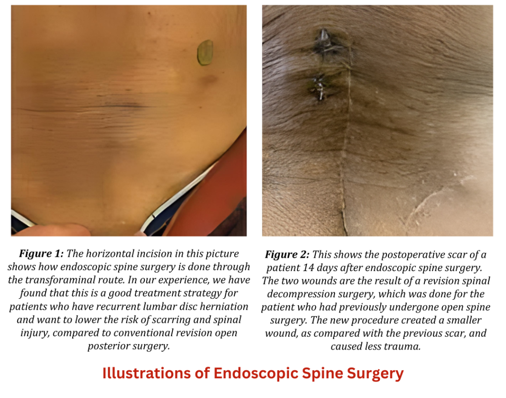 Illustrations of Endoscopic Spine Surgery