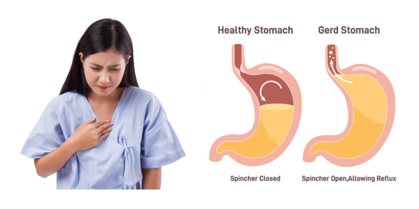 Healthy stomach vs GERD stomach