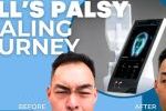 Before and after results of Emface Bell’s palsy treatment showing improved facial symmetry.