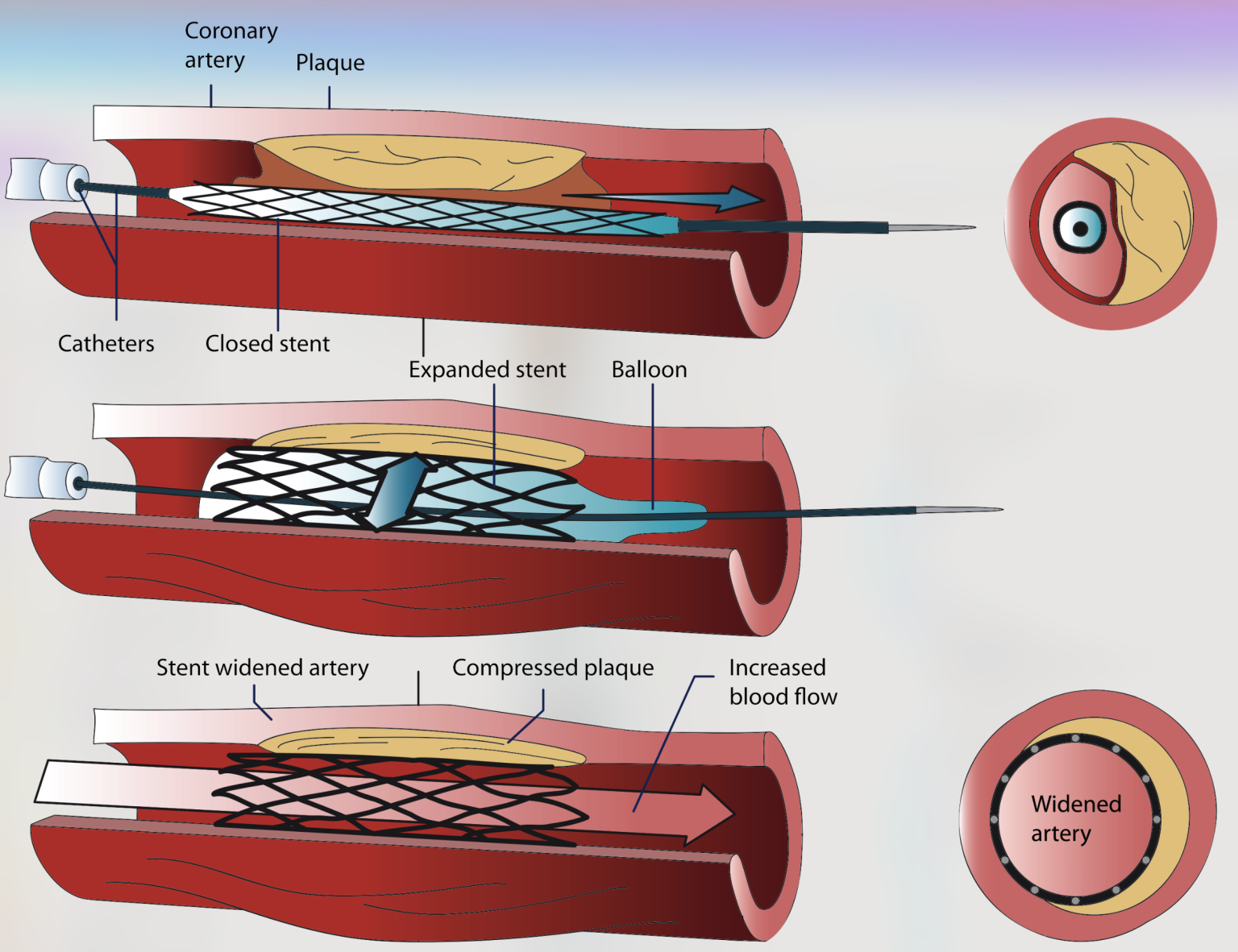 Ischaemic Heart Disease Singapore: A Silent Killer - Prime Magazine