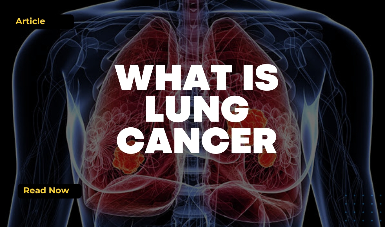 Illustration of human lungs showing highlighted tumour growths with the text “What Is Lung Cancer”.