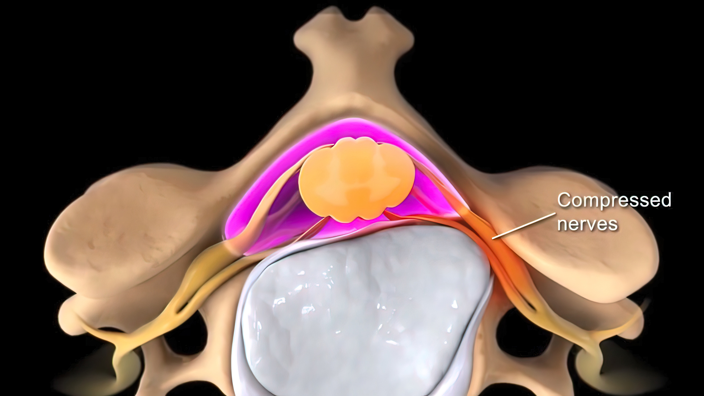 medical illustration showing spinal disc pressing on compressed nerves causing back pain