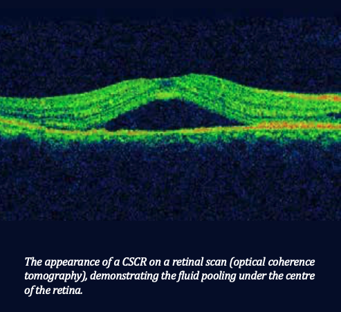 Retinal scan (CSCR)
