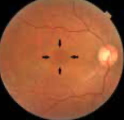 Retina fundus image